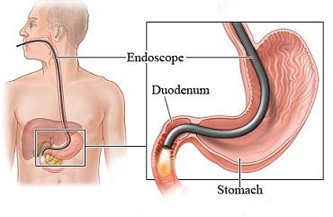 Endoscopy cost in Ahmedabad
