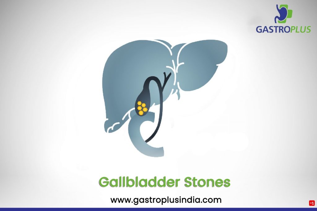 Gall Bladder Stone at Gastro Plus Hospital